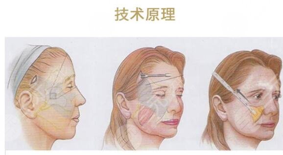 高亞東醫(yī)生拉皮手術(shù)真人案例分享