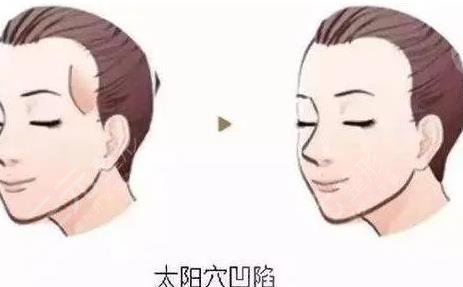 太陽穴填充