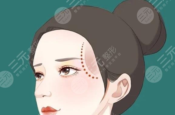 太陽穴填充