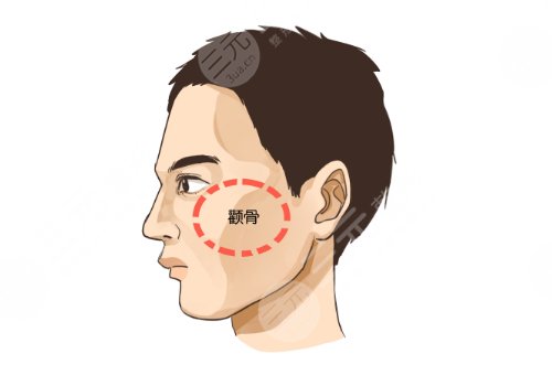 西京醫(yī)院顴骨內推手術多少錢