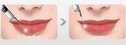 張曼醫(yī)生做唇排名第幾？醫(yī)生特點介紹，唇部整形案例來襲！