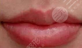 張曼醫(yī)生做唇排名第幾？醫(yī)生特點介紹，唇部整形案例來襲！