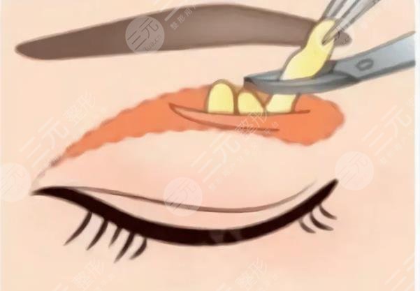 腫眼泡