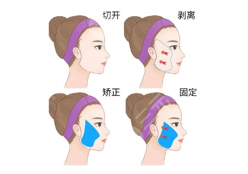 小拉皮手術(shù)價(jià)格一覽表