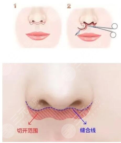 北京張曼美容醫(yī)生怎么樣？個人資料，擅長唇部整形與人中縮短手術(shù)