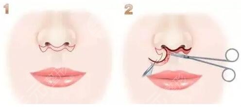 張曼醫(yī)生做人中手術(shù)好嗎？體察技術(shù)實力|坐診醫(yī)院介紹，附有人中縮短案例結(jié)果