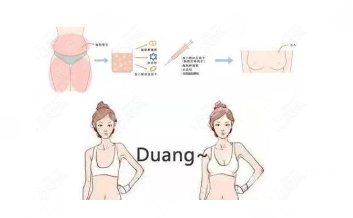 豐胸醫(yī)生項(xiàng)力源|項(xiàng)力源豐胸怎么樣?