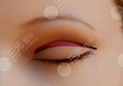 鄭州集美做雙眼皮修復(fù)多少錢