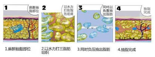 北京王東醫(yī)生做脂肪修復(fù)相關(guān)案例