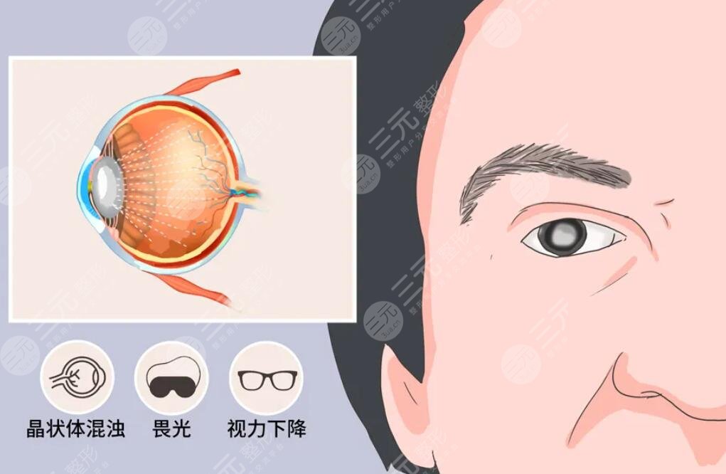 白內(nèi)障