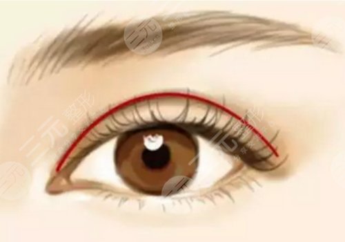 鄭州集美做眼綜合雙眼皮怎么樣