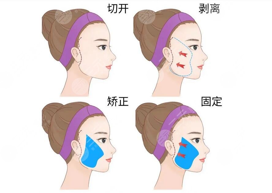 北醫(yī)三院拉皮手術(shù)多少錢?