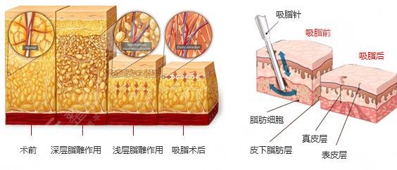 齊永樂醫(yī)生吸脂瘦大腿案例