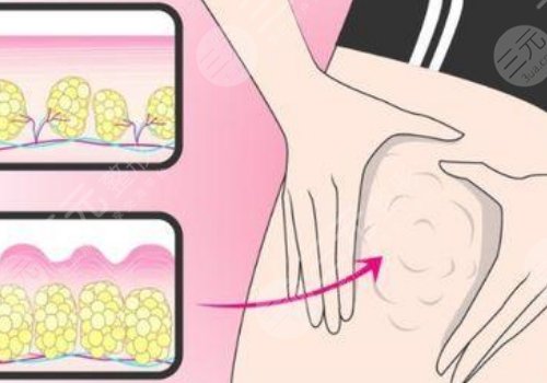 鄭州華領(lǐng)整形抽脂怎么樣