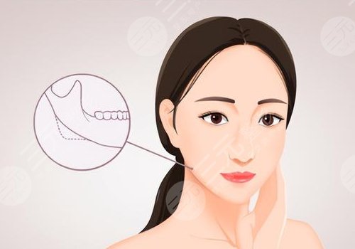 下頜角整形手術(shù)多少錢