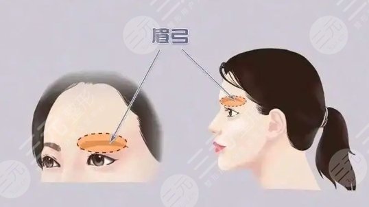眉骨整形