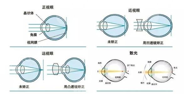 東莞人民醫(yī)院眼科近視眼矯正案例