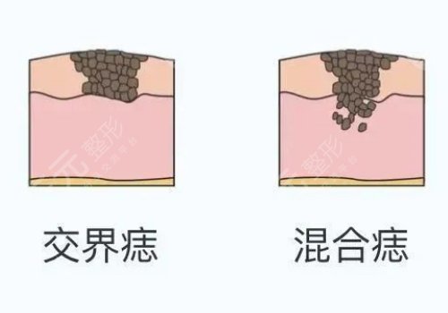 臧夢青案例
