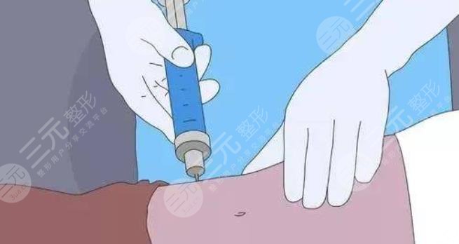 楊浦區(qū)中心醫(yī)院整形美容科腰腹環(huán)吸案例