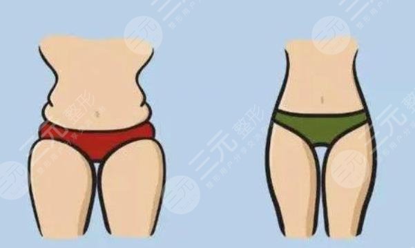 北京大學第三醫(yī)院整形外科吸脂案例