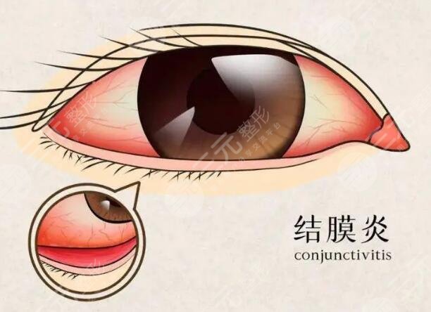 結(jié)膜炎