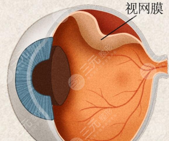 視網(wǎng)膜脫離