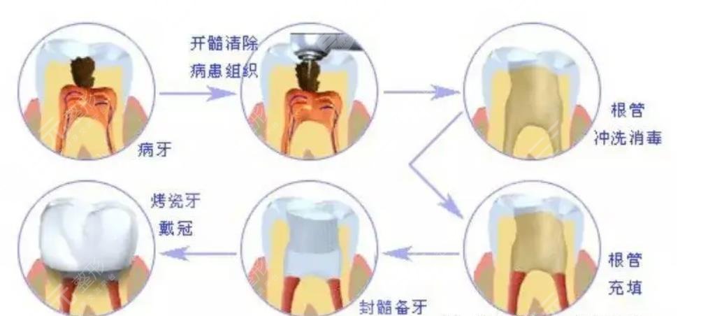 上海第六人民醫(yī)院牙齒做根管案例分享