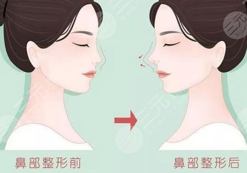 上海第九醫(yī)院隆鼻前后對(duì)比