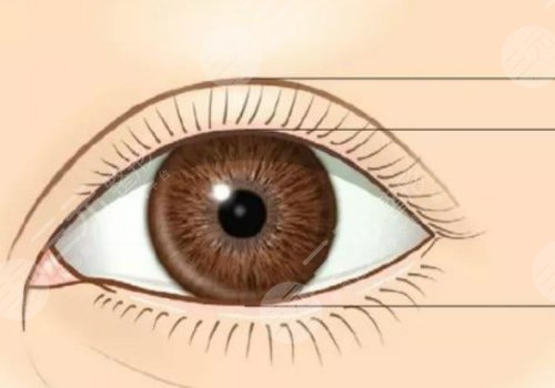 許蓮姬雙眼皮多少錢