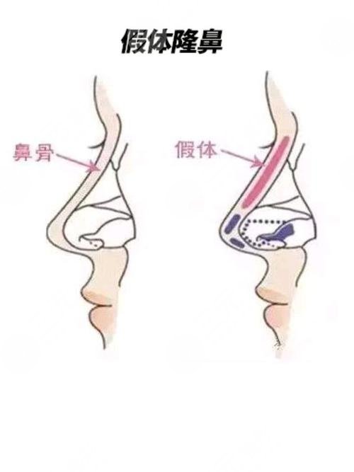 成都周順波做鼻子風(fēng)格