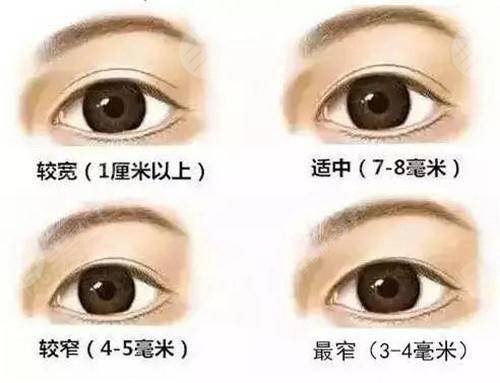 青島王志國醫(yī)生雙眼皮案例反饋