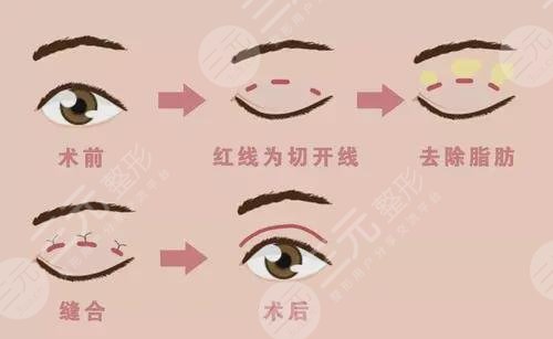 青島王志國醫(yī)生雙眼皮案例反饋
