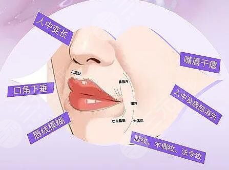 人工韌帶提升面部下垂安全嗎？多久能恢復(fù)？效果可以維持多長(zhǎng)時(shí)間？