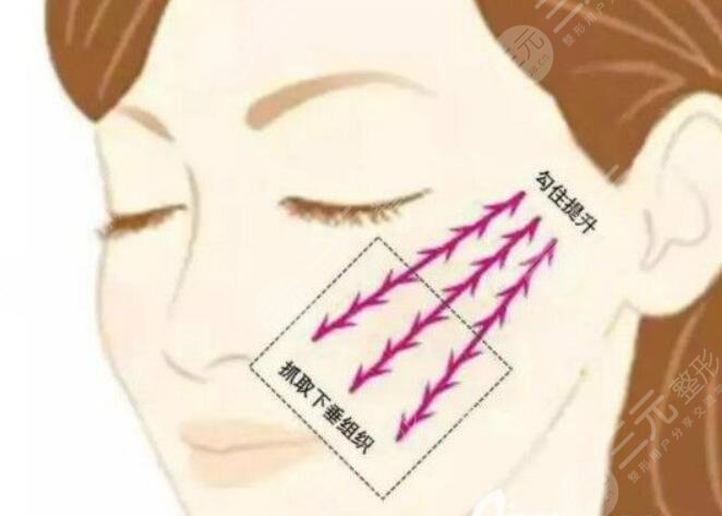 埋線提升