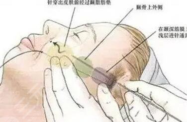 埋線提升