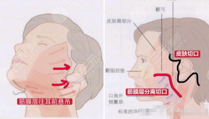 拉皮