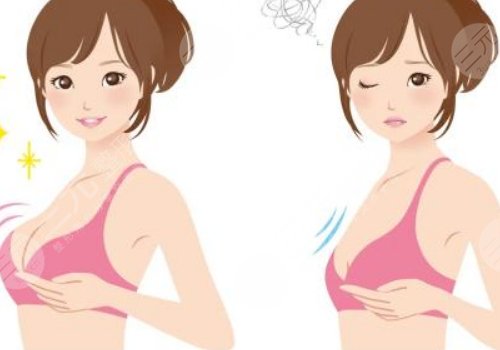 隆胸假體牌子前十名