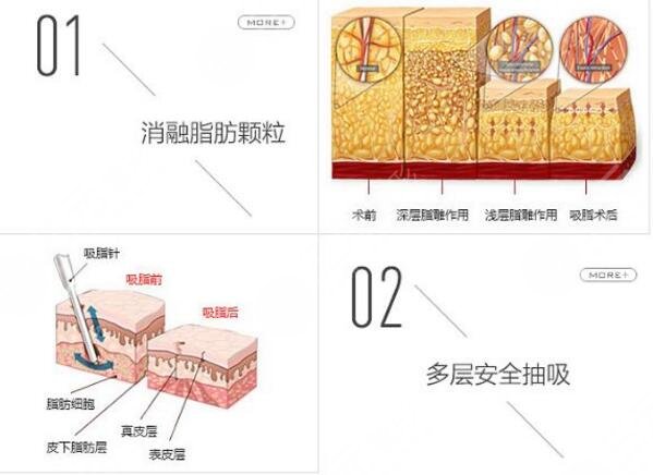腰腹吸脂