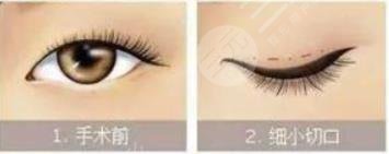 雙眼皮