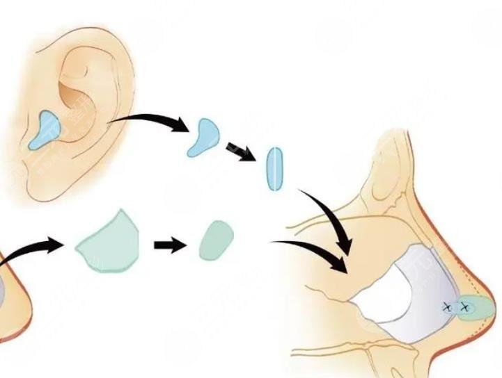 房志強(qiáng)醫(yī)生隆鼻案例參考