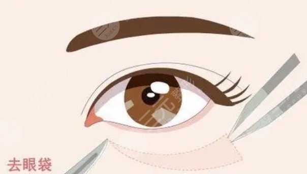 安徽省立醫(yī)院去眼袋案例