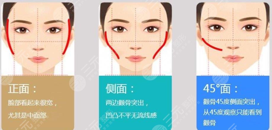 顴骨