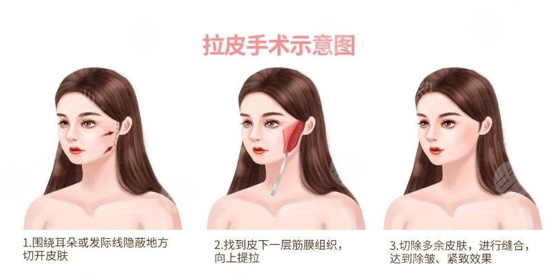 王劼醫(yī)生面部抗衰老手術(shù)案例