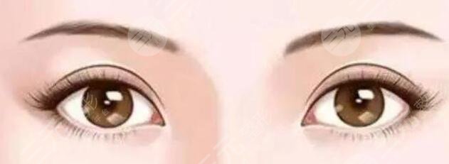 雙眼皮