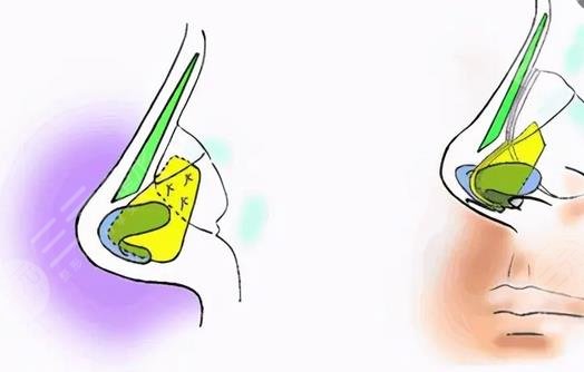 高順福做鼻子案例參考