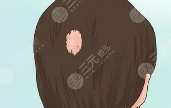 植發(fā)
