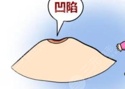 乳頭內(nèi)陷
