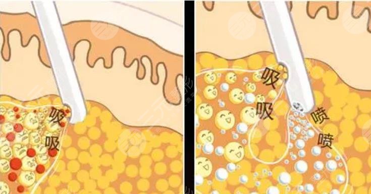 腰腹抽脂