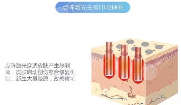 點陣激光