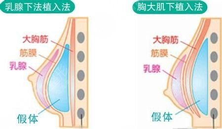 馬靜醫(yī)生隆胸案例